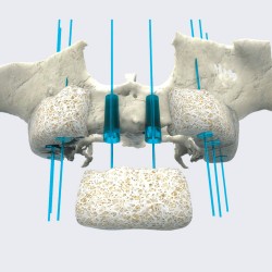 MAXGRAFT BONEBUILDER BLOCK