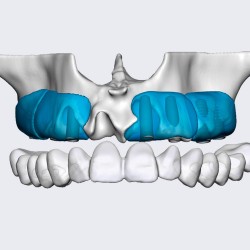 MAXGRAFT BONEBUILDER BLOCK